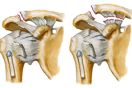 a clavicularis-acromialis ízület deformáló artrózisa