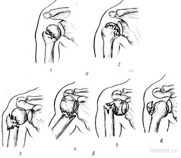 Перелом хирургической шейки плеча. Переломы головки и анатомической шейки плечевой кости. Переломы и вывихи головки плечевой кости. Перелом хирургической шейки плечевого сустава. Перелом анатомической шейки плечевой кости.