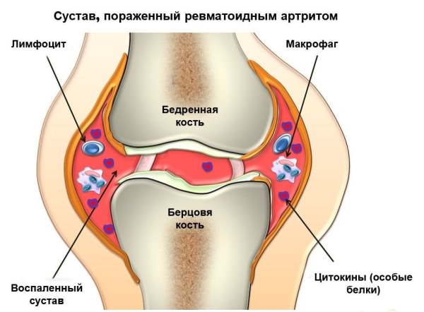 a bokaízület deformáló artrózisának tünetei 1 fok