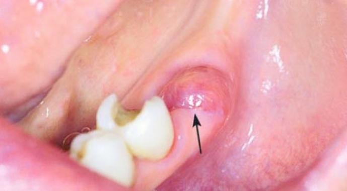 Tooth extraction: complications, swelling, bleeding, temperature
