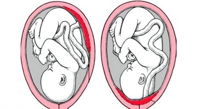 Vad betyder placenta previa på livmoderns främre vägg och vad påverkar det?