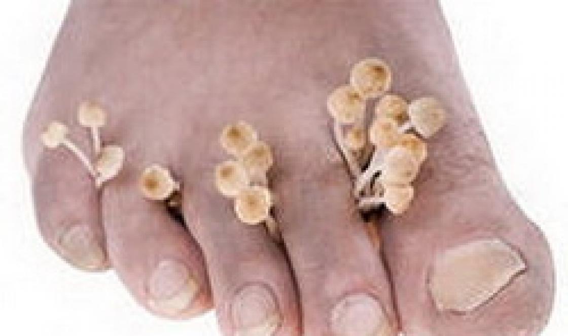 Kaj morate vedeti o glivicah na nohtih in stopalih ter njihovem zdravljenju