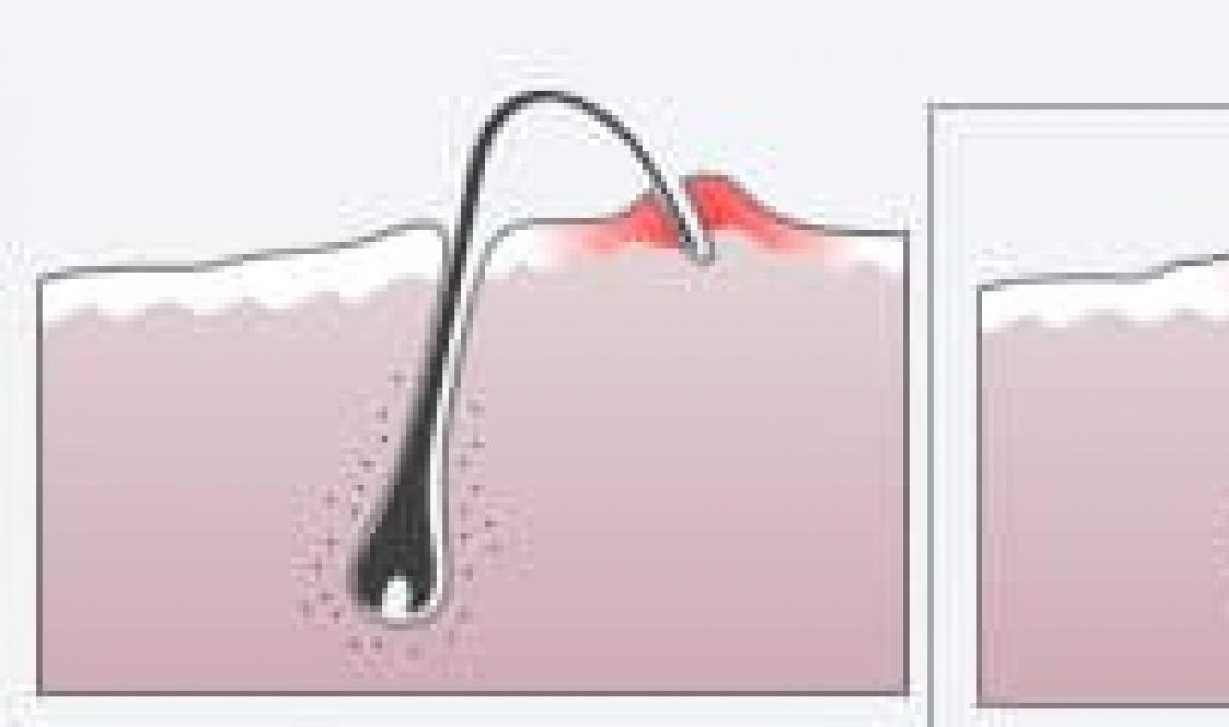 hogyan lehet megszabadulni a benőtt szőrszálaktól hogyan kell eltávolítani a benőtt szőrszálakat otthon