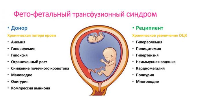 Ultrazvuk i dopler kriterijumi za dijagnostiku varijanti feto-fetalne transfuzije i selektivnog usporavanja rasta jednog od monozigotnih blizanaca.