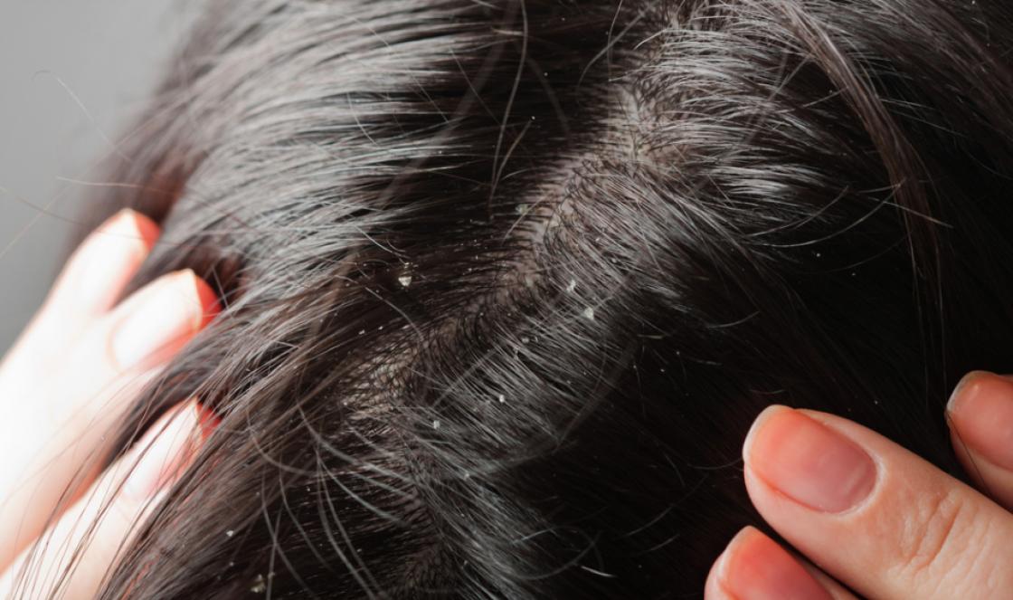 Dry dandruff without hair loss