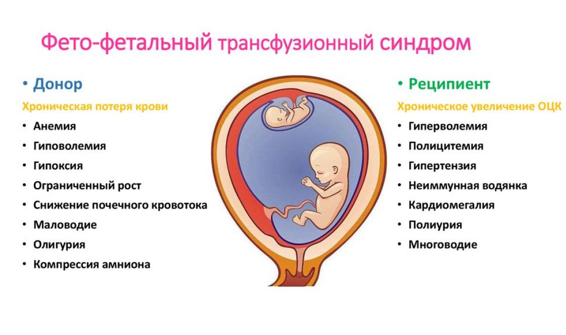 Ultrazvučni i Dopler kriterijumi za dijagnostiku varijanti feto-fetalne transfuzije i selektivnog usporavanja rasta jednog od monozigotnih blizanaca.