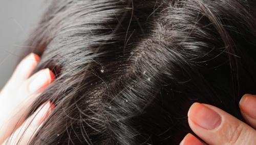 Dry dandruff without hair loss